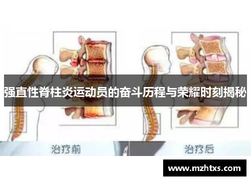 强直性脊柱炎运动员的奋斗历程与荣耀时刻揭秘
